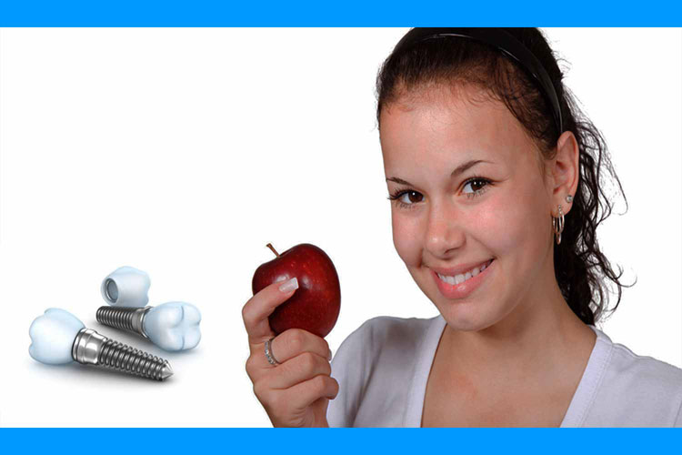 Impianti dentali: impiantologia e riabilitazioni su impianti