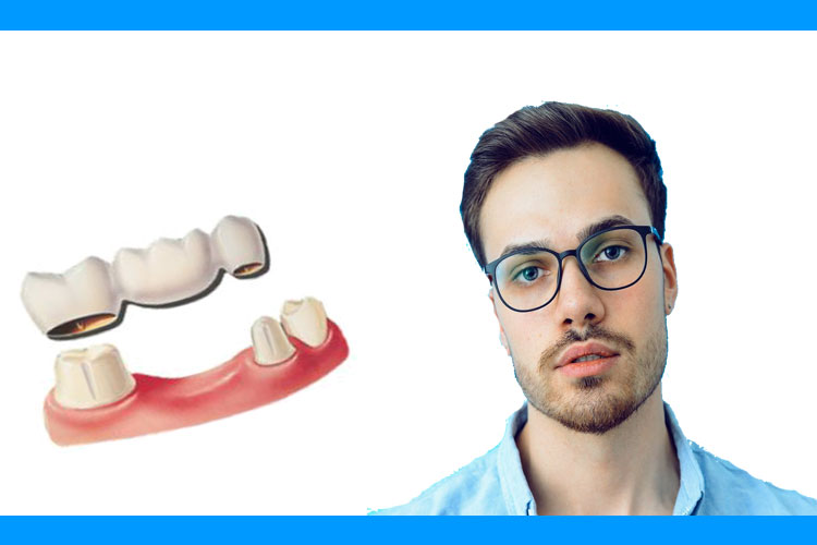 Protesica dentale fissa e rimovibile: ponti e corone in porcellana, protesi su impianti, protesi parziali e totali